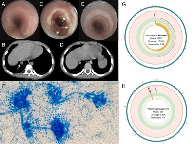 Unusual Talaromyces marneffei and Pneumocystis jirovecii coinfection in a child with a STAT1 mutation: A case report and literature review